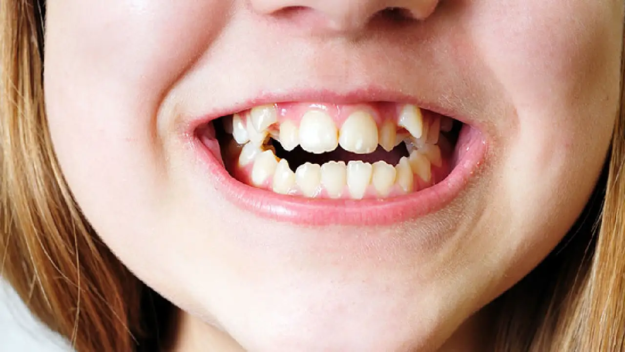 Dientes torcidos: más que una cuestión estética